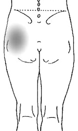 股OAの痛み部位_後面.jpg